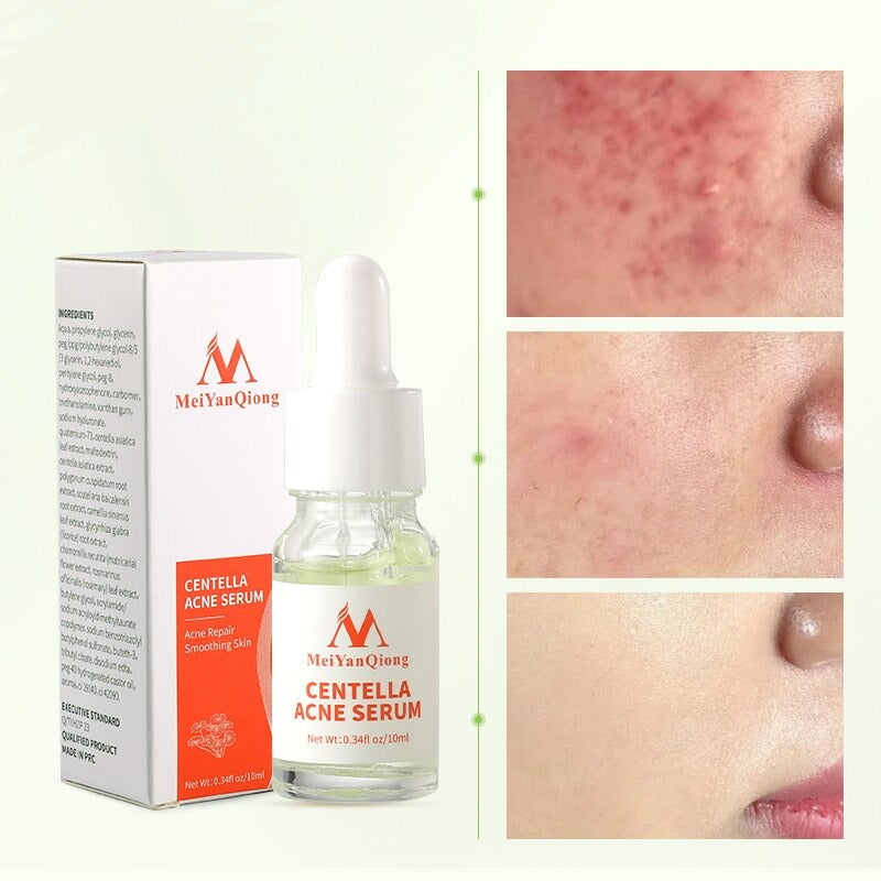 Asiatica Acne Removing Essence