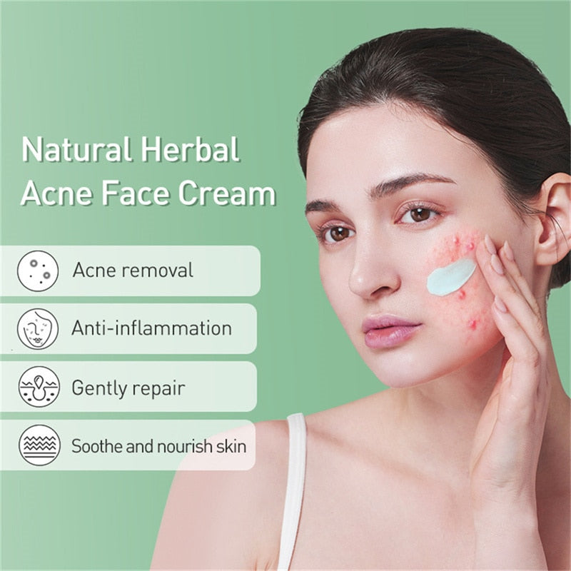 Acne Removal Whitening Cream