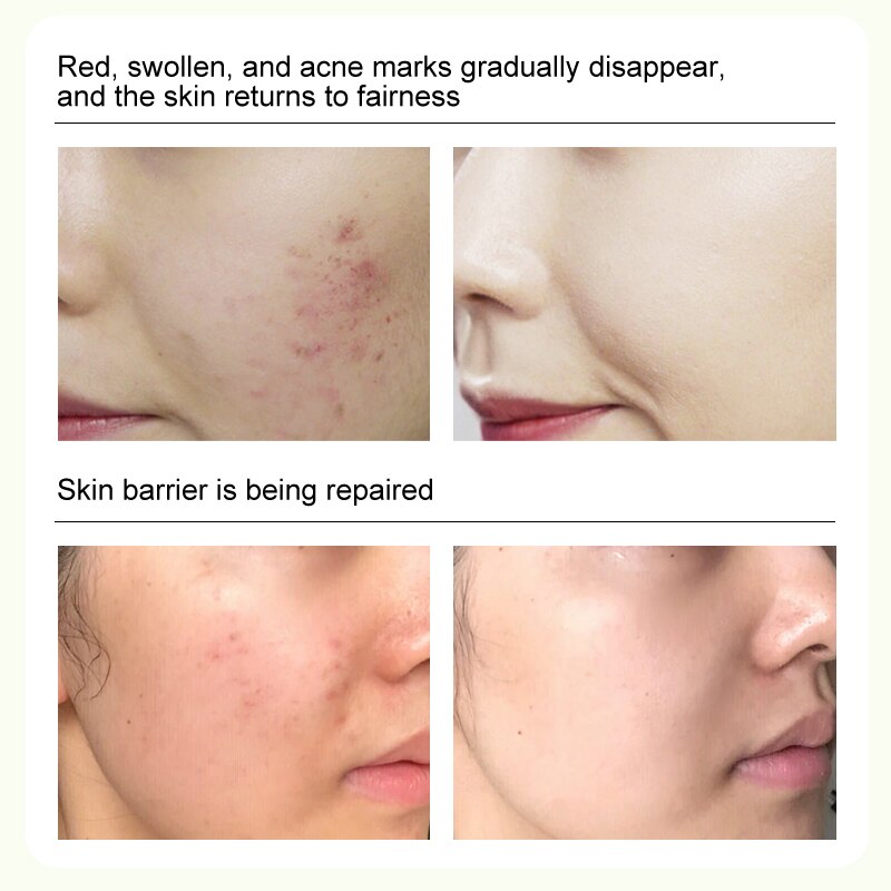 Asiatica Acne Removing Essence