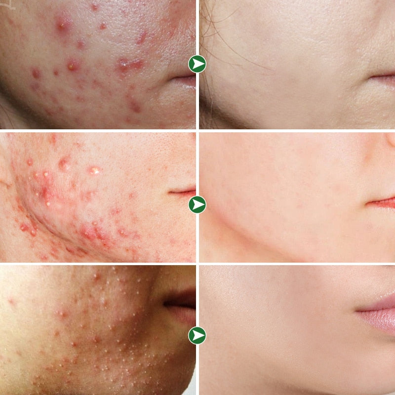 Acne Removal Whitening Cream